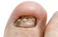 A big nasty toenail fungal disease large