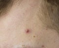 Big red pimple on the man`s forehead, close-up, problem skin, white-head Royalty Free Stock Photo