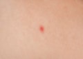 Big red pustules on the skin close-up. Royalty Free Stock Photo