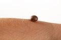 Big tick on human arm.