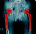 Bilateral hip replacement x-ray imge Royalty Free Stock Photo