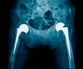 Bilateral hip replacement