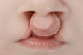 Bilateral lip and palate cleft. Royalty Free Stock Photo