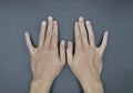 Bilateral little finger deviation in Asian young man. Bilateral hand deformities. Abnormal fingers extension