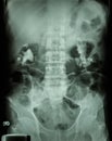 Bilateral renal calculi (staghorn) Royalty Free Stock Photo