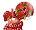 Bile Duct Cancer Royalty Free Stock Photo