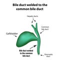 Bile duct welded to the common bile duct. Pathology of the gallbladder. Cholecystitis.