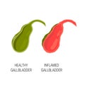 Inflamed and healthy gallbladder, vector concept
