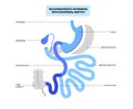 Biliopancreatic diversion procedure