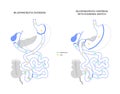 Biliopancreatic diversion procedure