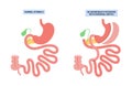 Biliopancreatic diversion procedure