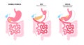 Biliopancreatic diversion procedure