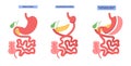 Biliopancreatic diversion procedure