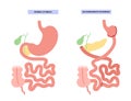 Biliopancreatic diversion procedure