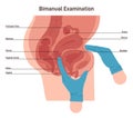 Bimanual examination. Gynecologist check-up. Female pelvic examination