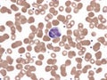 Binucleated lymphocyte in peripheral blood (Natalizumab). Royalty Free Stock Photo