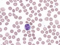 Binucleated lymphocyte in peripheral blood (Natalizumab). Royalty Free Stock Photo