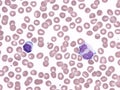 Binucleated lymphocyte in peripheral blood (Natalizumab). Royalty Free Stock Photo