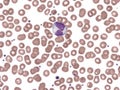 Binucleated lymphocyte in peripheral blood (Natalizumab). Royalty Free Stock Photo