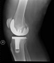 Bionic Knee Royalty Free Stock Photo