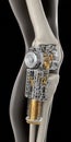 Bionic knee prosthesis concept integrating advanced mechanical design Royalty Free Stock Photo