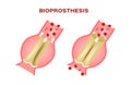 Bioprosthesis and an aortic valve replacement 