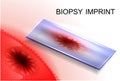 Biopsy imprint.diagnosis of cancer