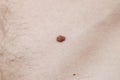 Birthmark on the human body close-up