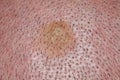 Birthmark or keratoma on the scalp of a young male close-up
