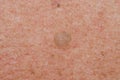 Birthmark of keratoma on the skin of an old mans body close-up