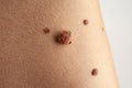 Birthmark that needs to be removed. Royalty Free Stock Photo
