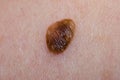 Birthmark or papilloma or Keratopapilloma on human skin closeup Royalty Free Stock Photo