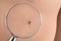 Birthmark of patient under magnifying glass, closeup. Visiting dermatologist