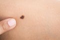 Birthmark on skin Royalty Free Stock Photo