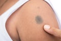 Birthmark on skin Royalty Free Stock Photo