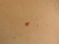 Birthmark on the skin