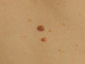 Birthmarks on the skin