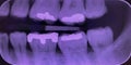 dental x-ray show front teeth roots and Amalgam fillings