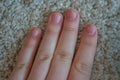 Biting damaged finger nails from anxiety, depression and skin picking. Conceptual imgae for anxiety, depression, stress and