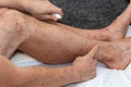 Bitten arms and legs by bloodthirsty insects in tropical countries, Lubricating itchy spots with ointment, Holiday health problems