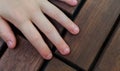 Bitten fingernails - bitten fingers. Close up of hand with bitten finger and fingernails.Close up shot of bad behavior or habit of