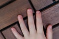 Bitten fingernails - bitten fingers. Close up of hand with bitten finger and fingernails