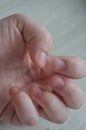 Bitten fingernails damaged due to anxiety disorders with damaged cuticles from skin picking. Conceptual for stress, depression or