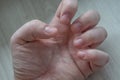 Bitten fingernails damaged due to anxiety disorders with damaged cuticles from skin picking. Conceptual for stress, depression or