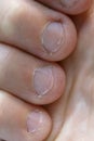 Bitten Fingernails