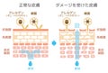 Sectional view of the skin illustration. Comparison of protection effect between healthy skin and wounded skin