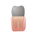 Black caries tooth ill, modern stomatology cabinet