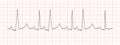 Black heart beat diagram on red graph paper. ECG chart. Pulse rhythm line. Cardio test sign. Cardiology hospital symbol