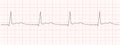 Black heart beat diagram on red graph paper. Electrocardiogram chart example. Cardiac rhythm line. Cardio test sign