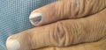 Black line on nails. Subungual melanoma.